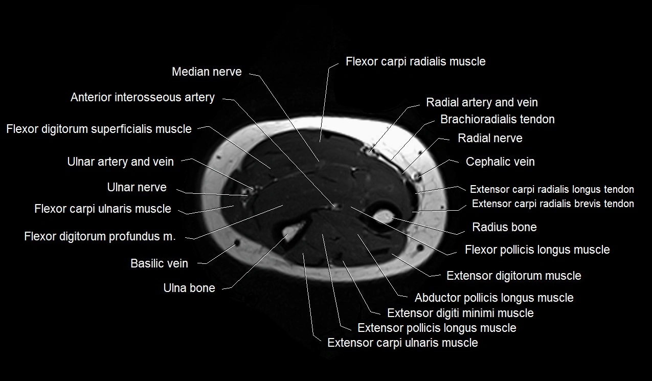 MRI 3T forearm axial cross sectional anatomy image 31.webp
